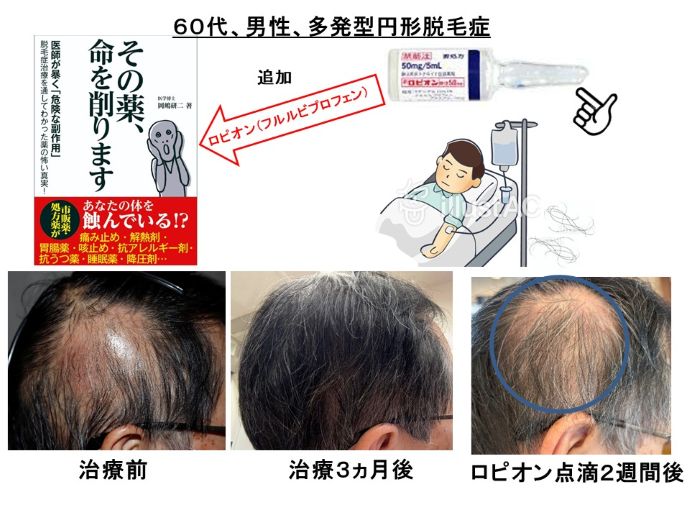 円形脱毛症　病院